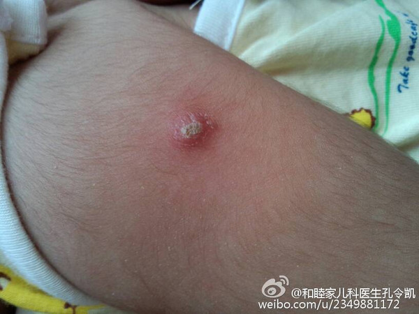 科技之光，最新卡介苗引领健康新纪元